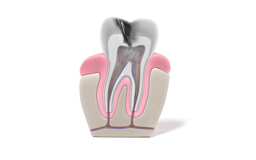 Terapia canalare del dente: cos’è e quando è necessaria