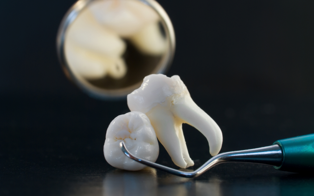 Cos’è l’endodonzia dentale e come funziona