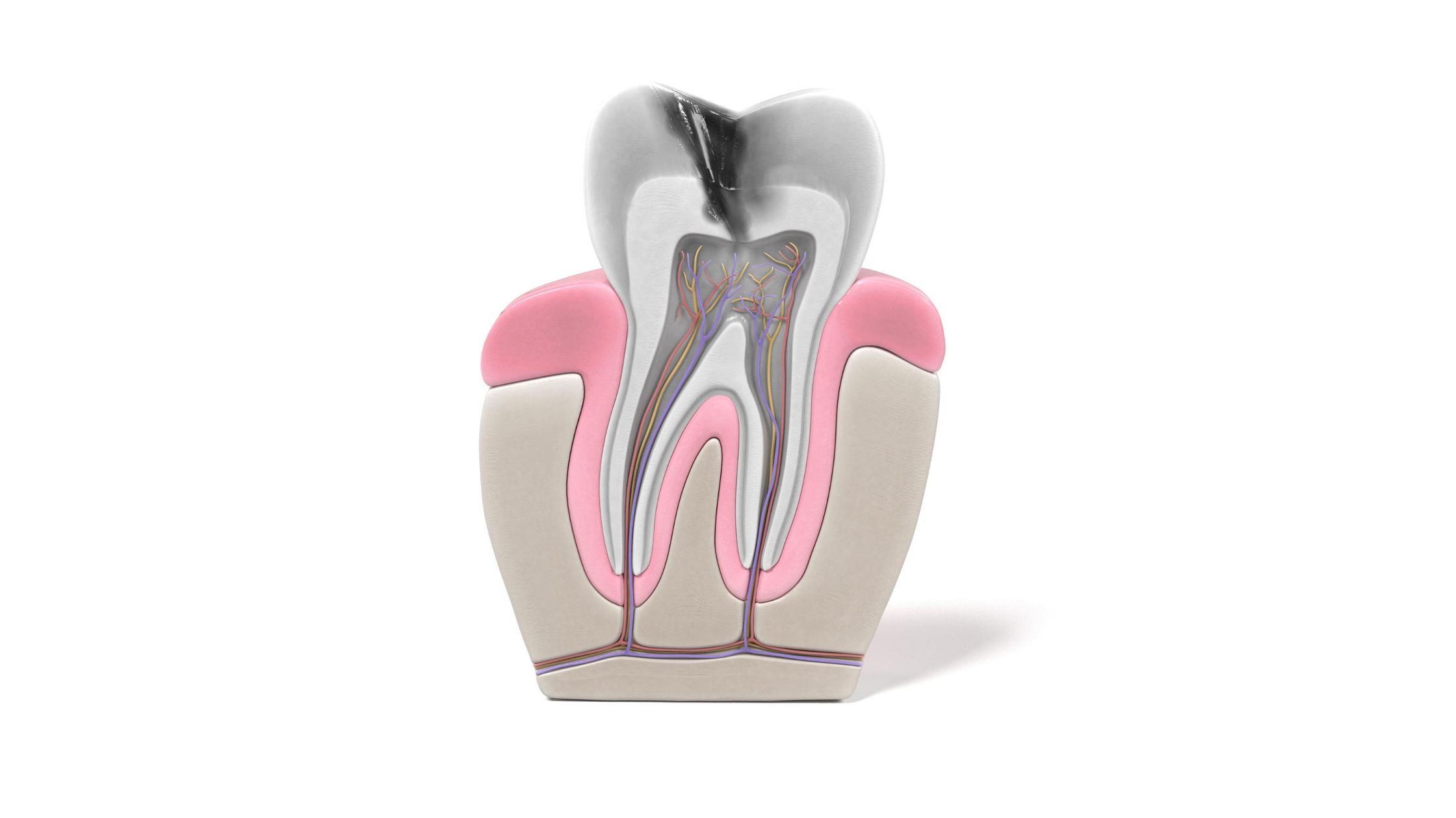 terapia canalare dente