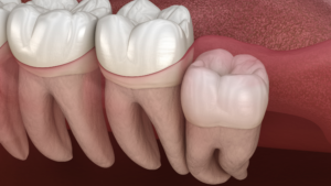 Dente del giudizio in crescita anomala