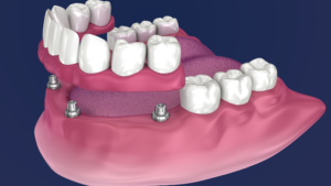 Protesi rimovibile overdenture