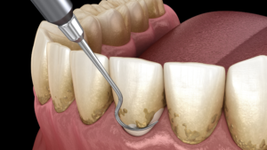 Rimozione tartaro