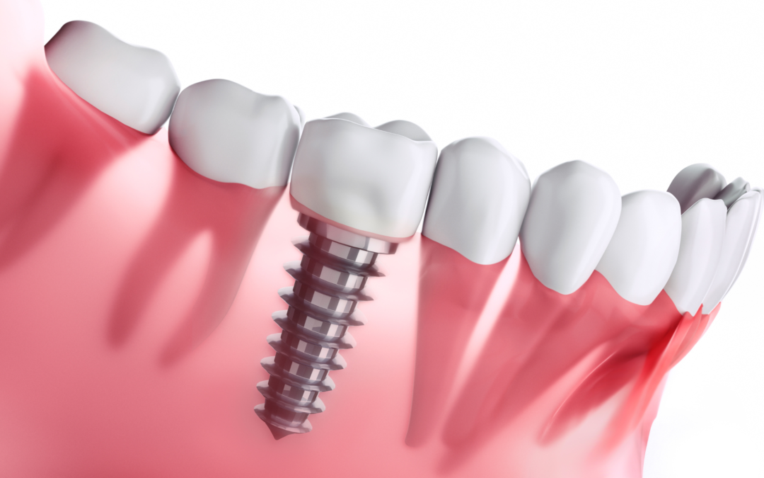 L’impianto dentale è doloroso?