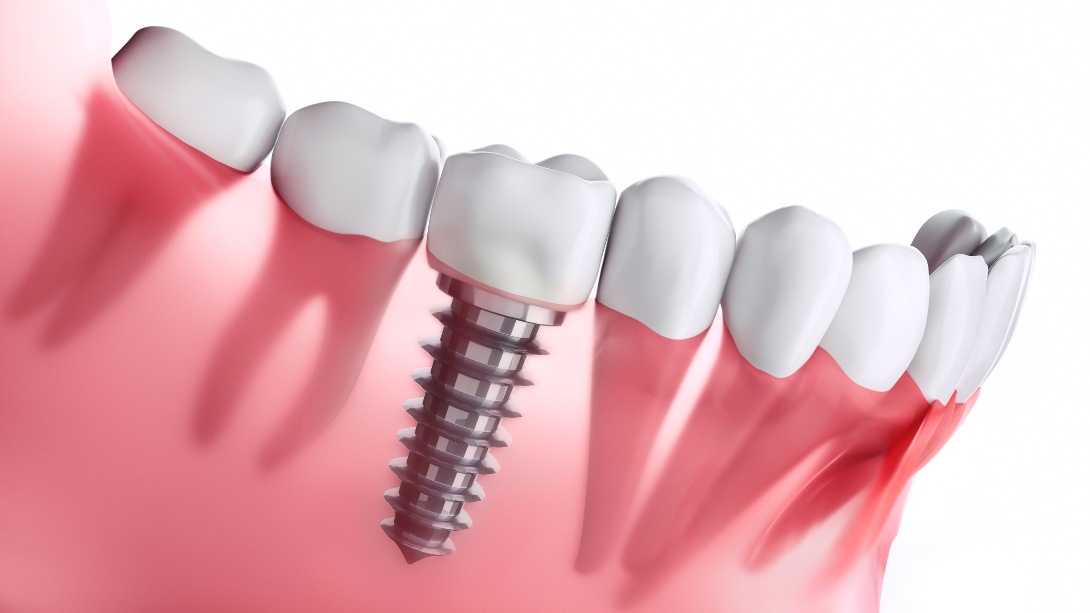 Impianto dentale è doloroso
