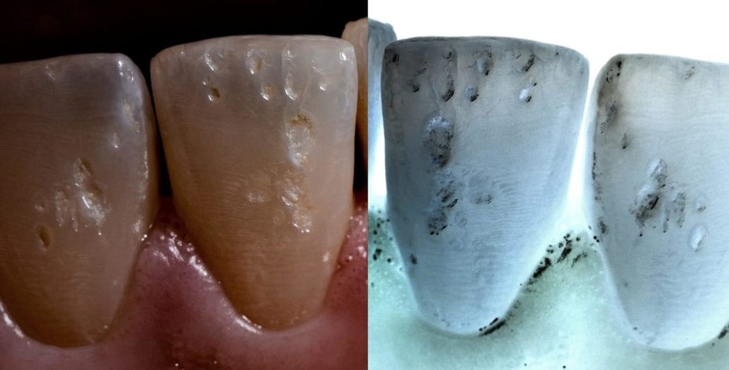 Danni ai denti provocati da un piercing orale. Fonte: AIDI - Associazione Igienisti Dentali Italiani