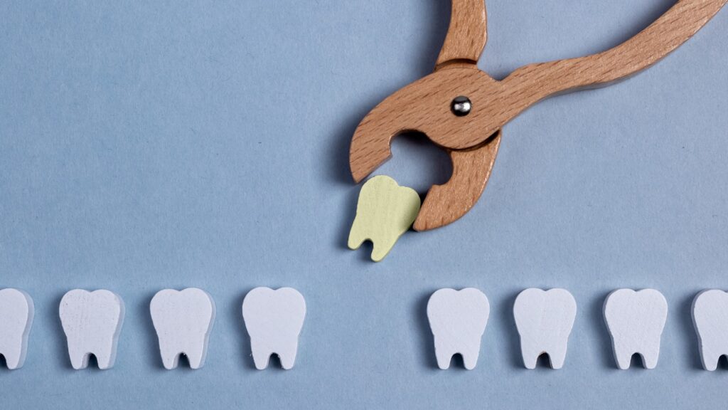 tempi di guarigione dopo estrazione dente