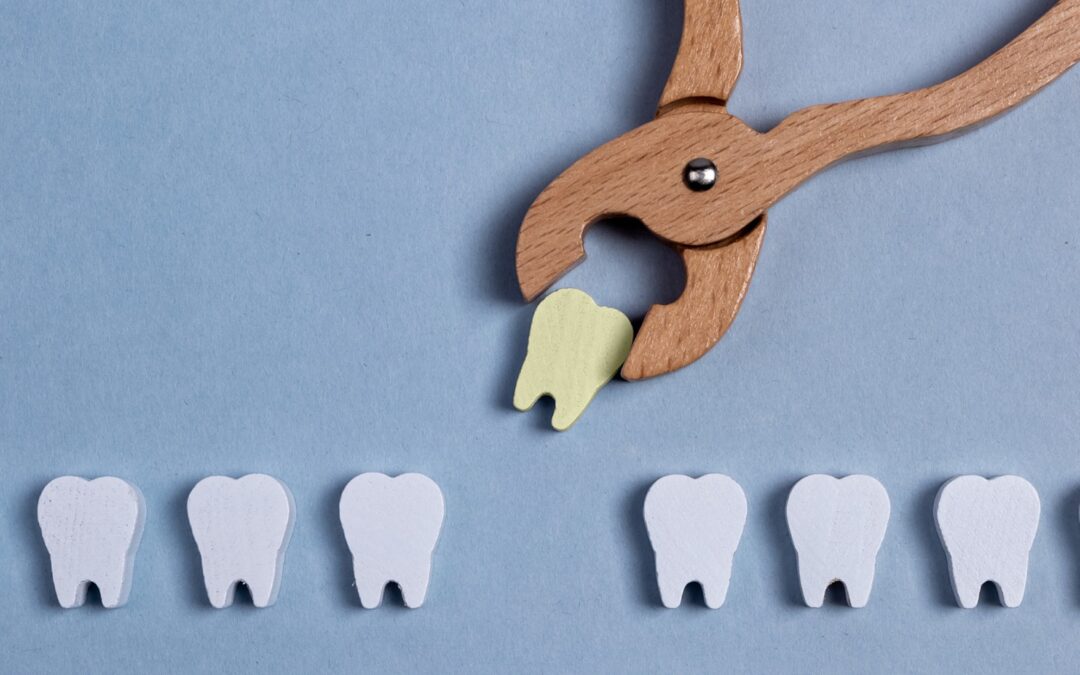 Quali sono i tempi di guarigione dopo l’estrazione di un dente?
