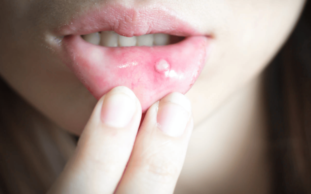 Mucocele al labbro: cos’è e come intervenire