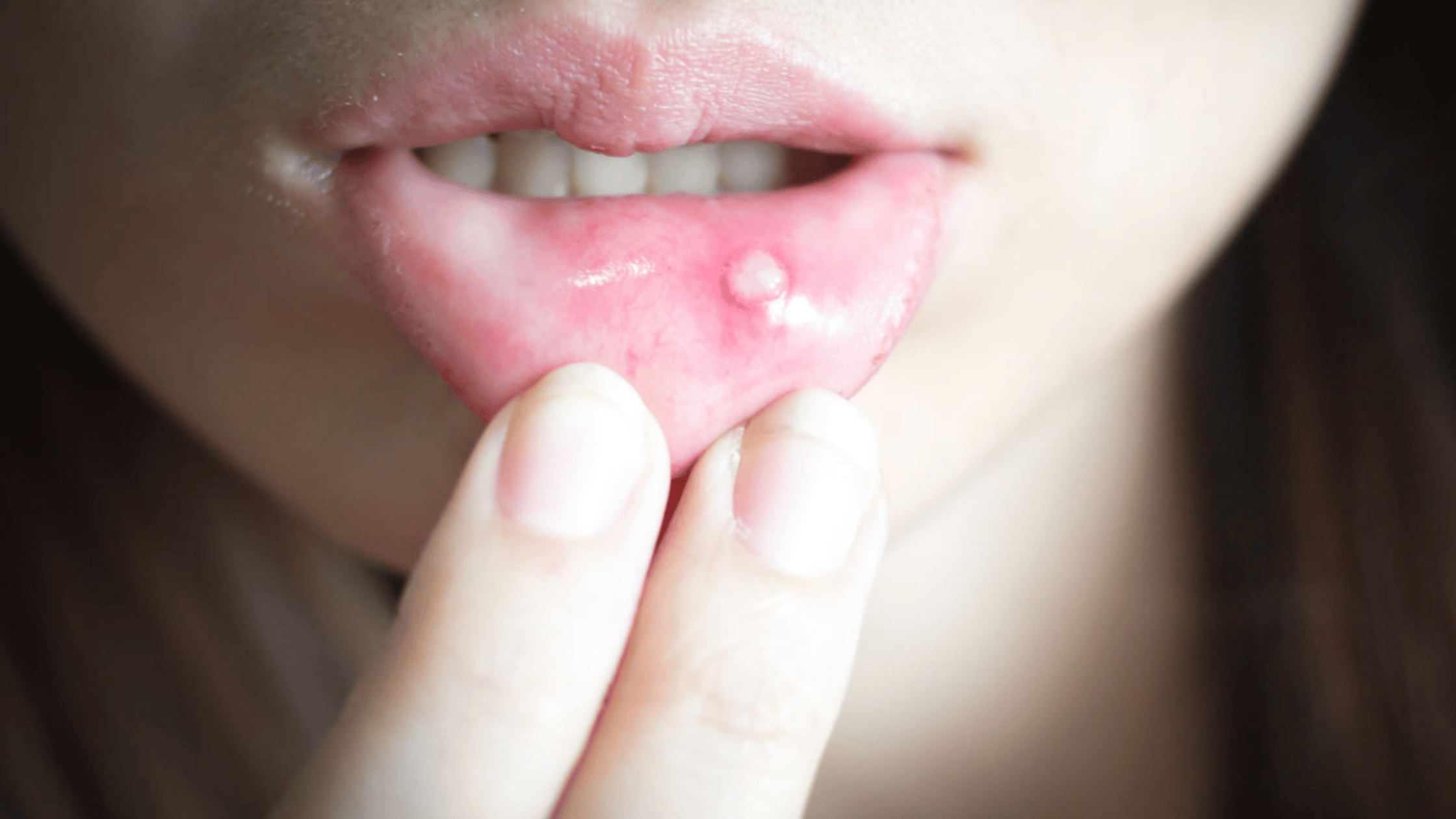 mucocele labbro