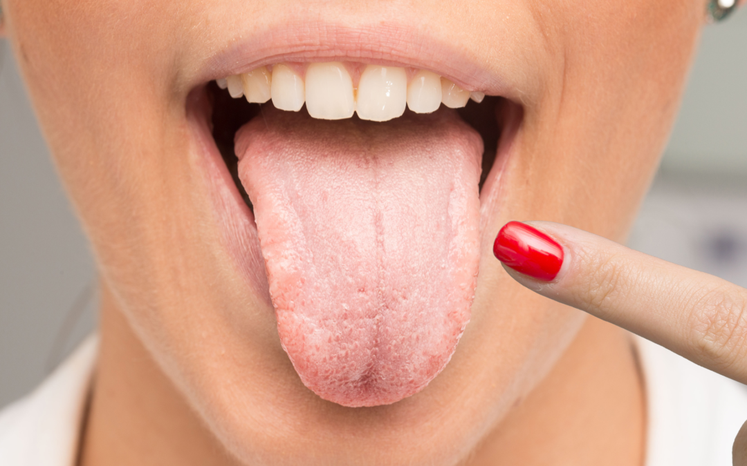 Glossite da stress: cause, forme e trattamenti più efficaci