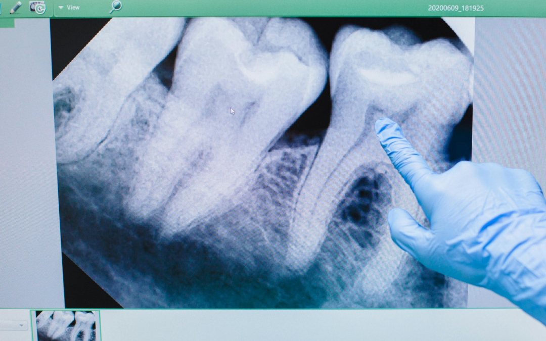 Estrazione dente del giudizio: quando è necessaria e cosa aspettarsi
