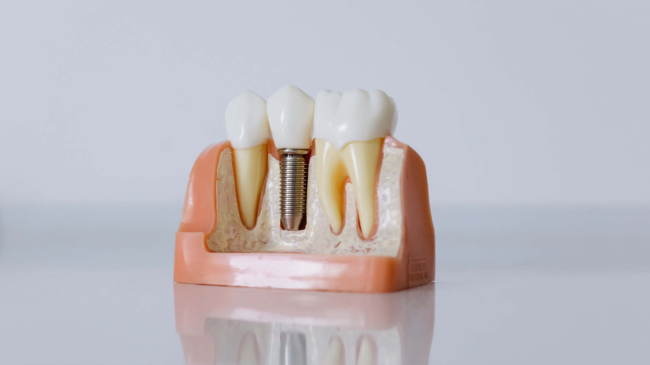 tipologie di impianti dentali