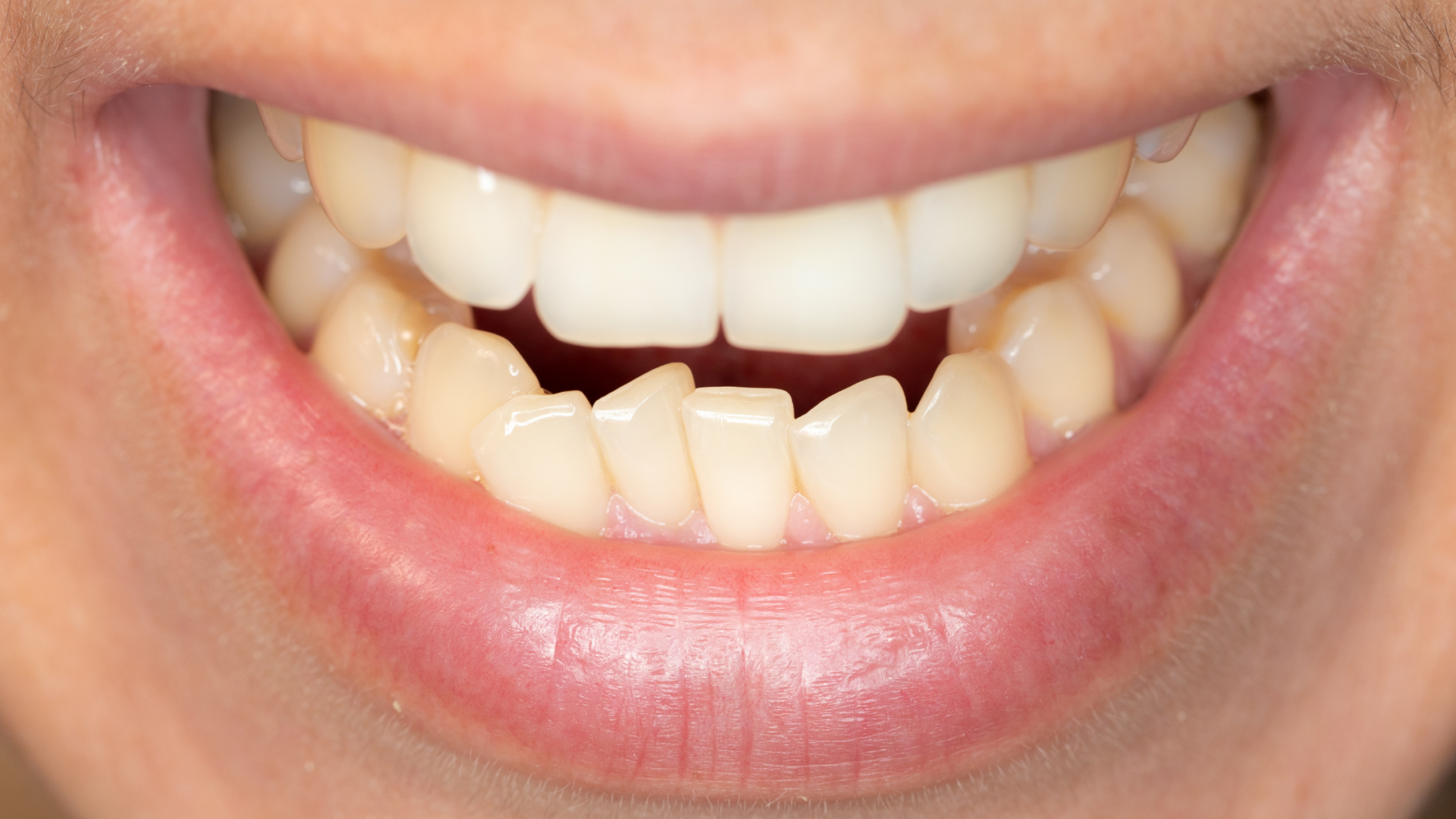 Affollamento dentale: origini e rimedi