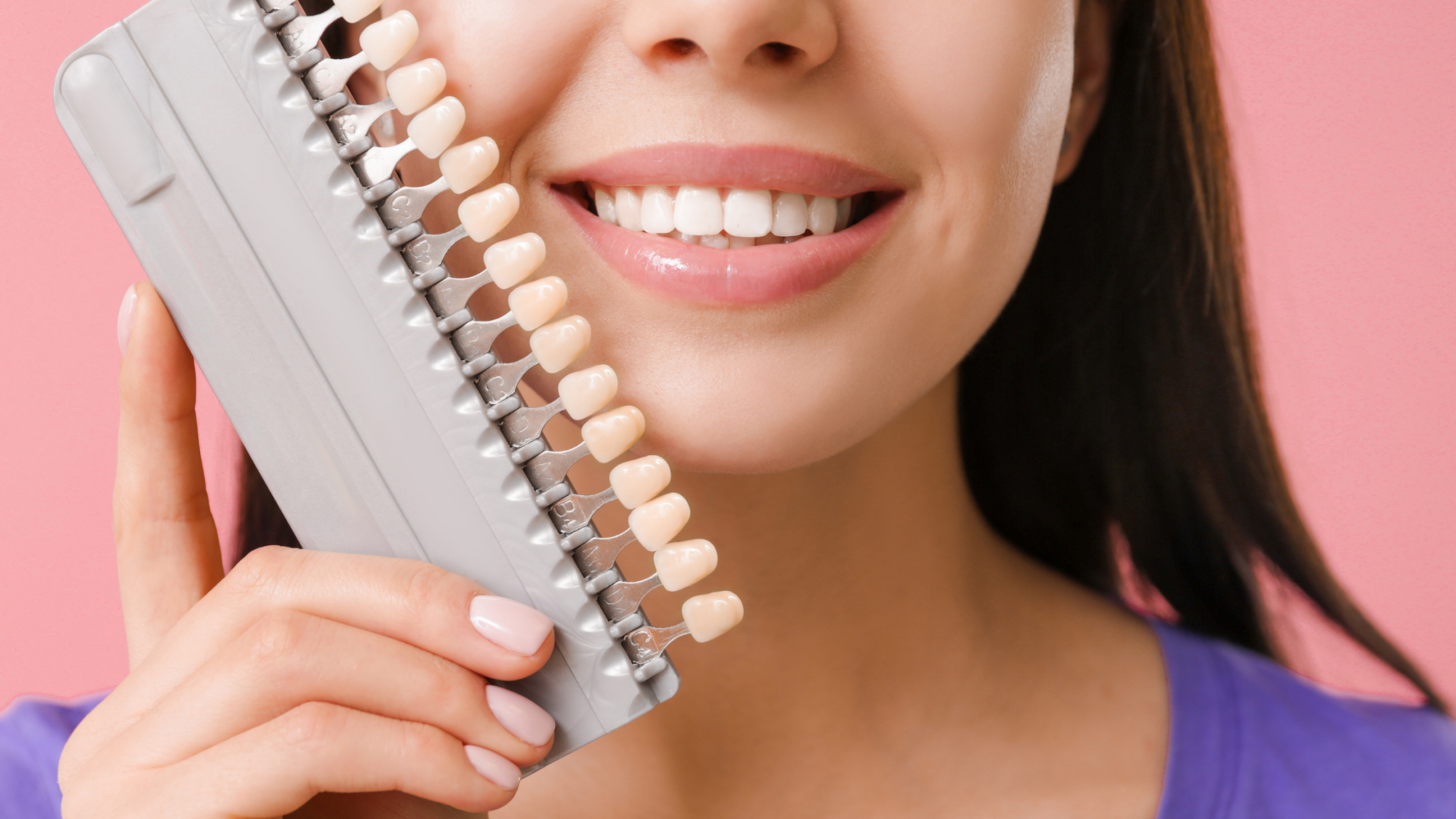 Cosa sono le faccette dentali e come vengono realizzate