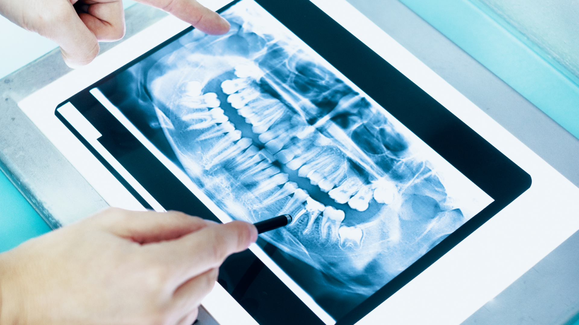 Granuloma al dente: cos’è e come si cura