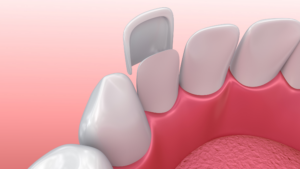 Rappresentazione virtuale delle faccette dentali