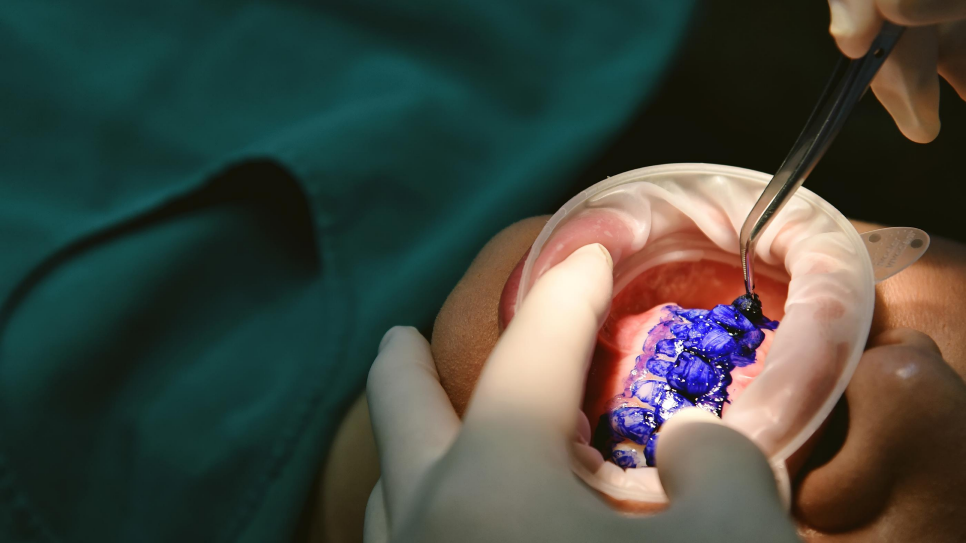 La rivoluzione della profilassi dentale si chiama GBT