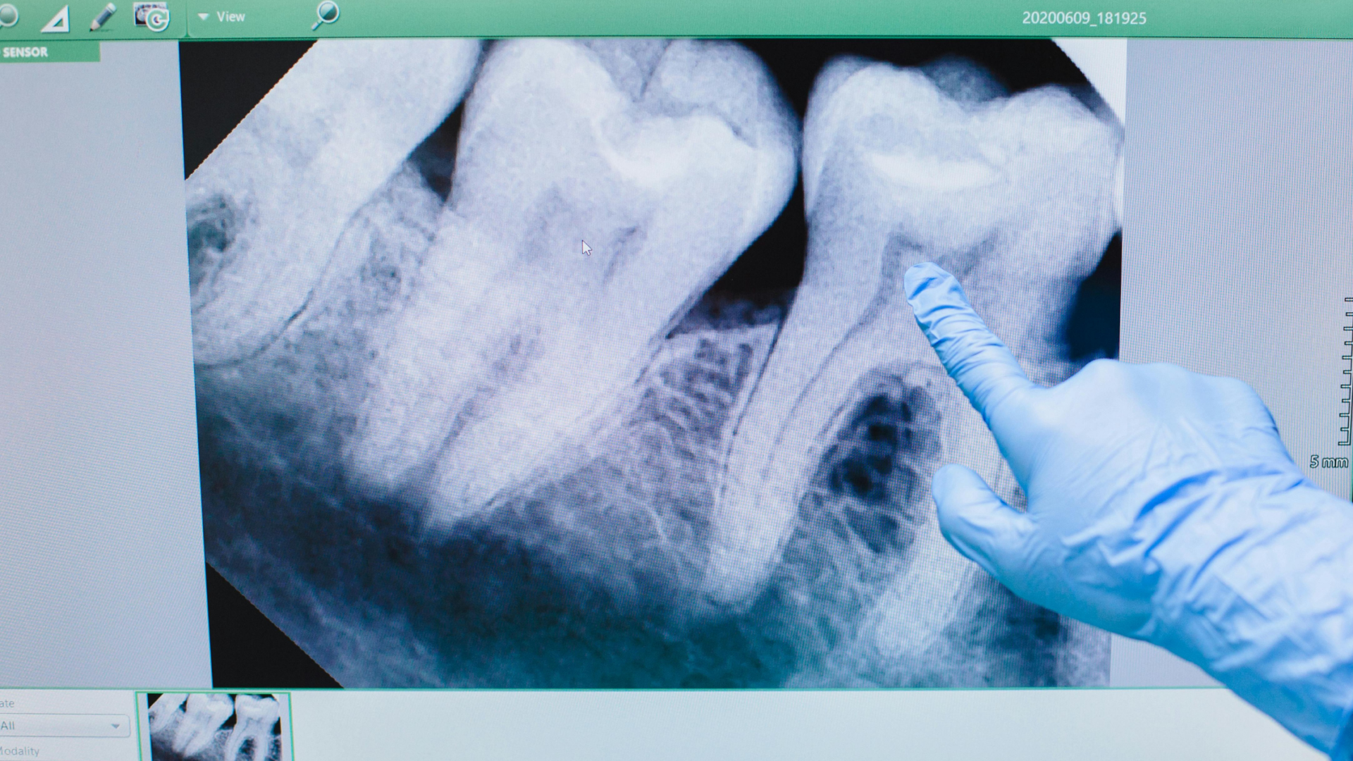 Estrazione dente del giudizio: quando è necessaria e cosa aspettarsi